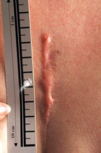 Micro-needling voor behandeling